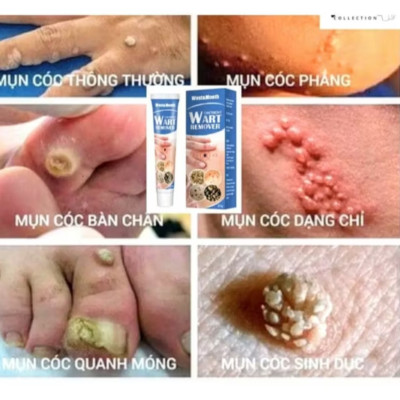 HỘP KEM BÔI TRỊ HẾT MỤN CÓC MỤN THỊT NÚT RUỒI DA THÂM SẠM 