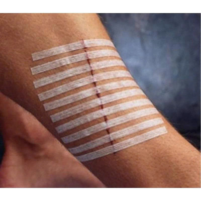 Miếng dán thay chỉ khâu da Steri-Strip R1547 12mm x 100mm (1/2IN x 4IN)