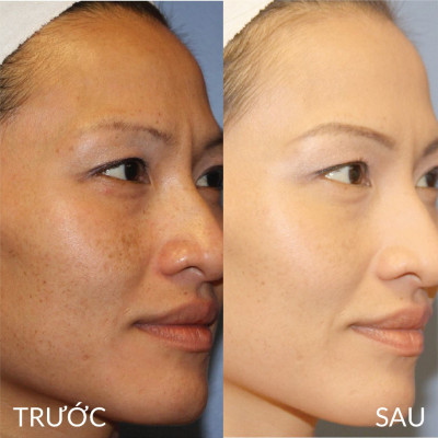 Kem Giảm Nám, Tàn Nhang, Đồi Mồi Yanhee Mela Cream (20g)