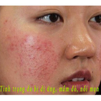 KEM DƯỠNG CHO DA NHẠY CẢM – PHỤC HỒI, ỔN ĐỊNH DA LARIAN+ 50ml