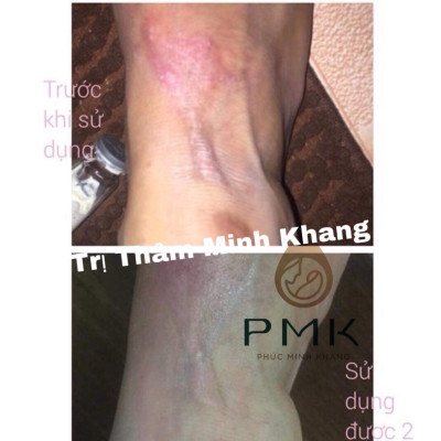 Combo 2 lọ Tinh Chất Mờ Thâm Minh Khang