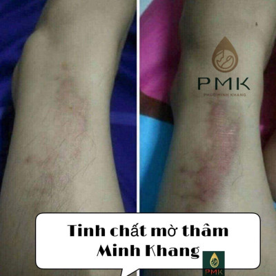 Combo 2 lọ Tinh Chất Mờ Thâm Minh Khang